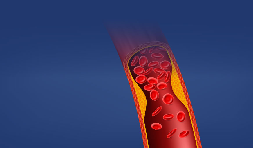 Profil lipidic (extins)